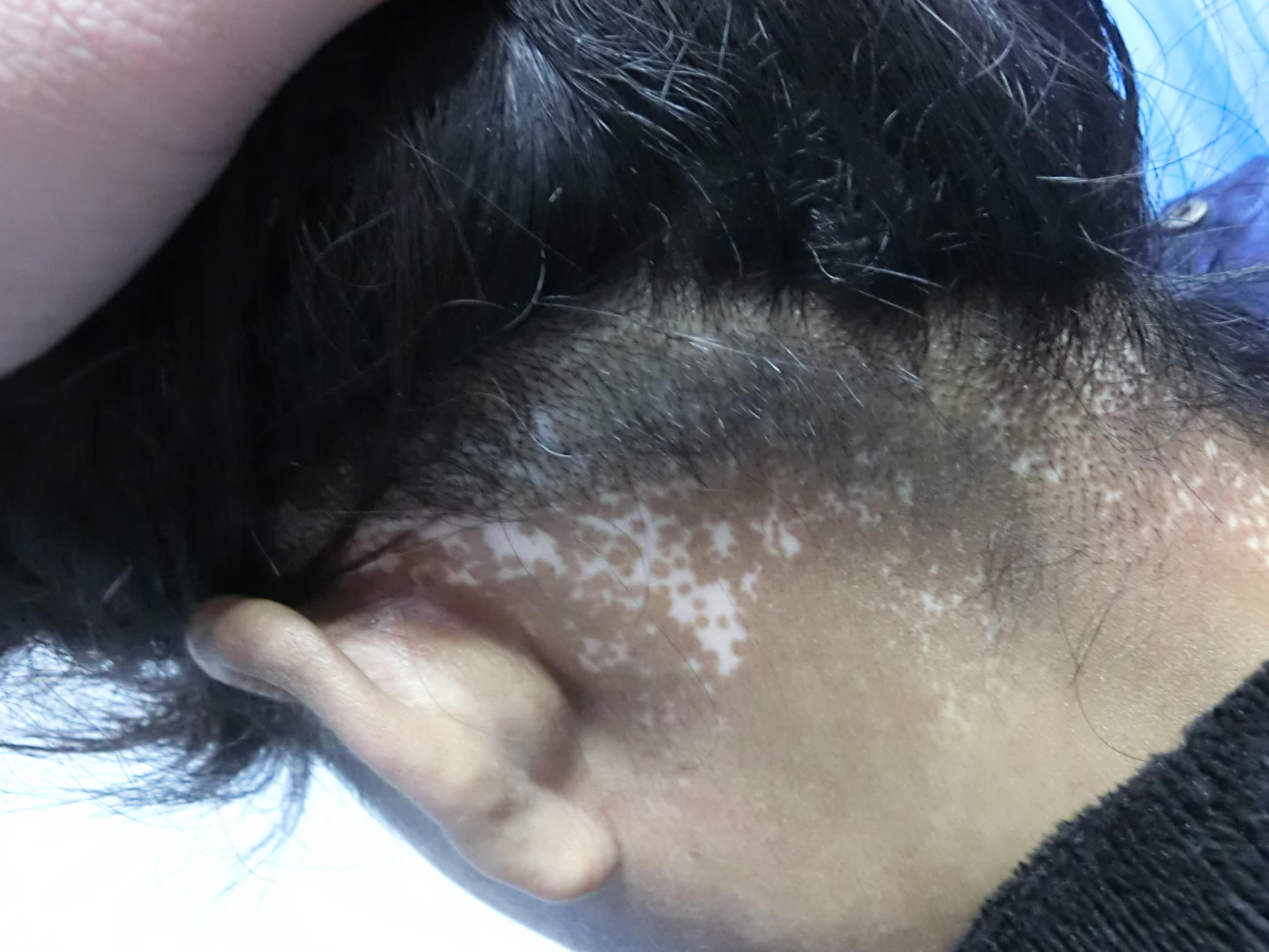 您好欢迎来到杭州白癜风咨询热线057187359179